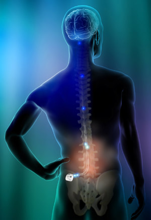 Oracle Pain Clinic Spinal Cord Stimulation